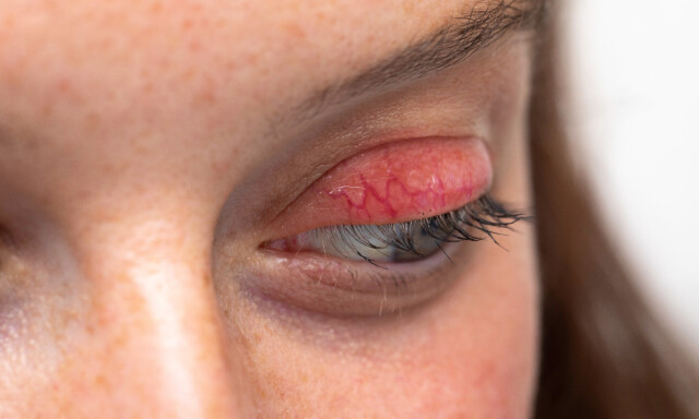 STI PÅ ØYET: Hordeolum som det heter på fagspråket, skyldes oftest bakterien gule stafylokokker. FOTO: NTB Scanpix / Shutterstock / sruilk STI PÅ ØYET: Hordeolum som det heter på fagspråket, skyldes oftest bakterien gule stafylokokker. FOTO: NTB Scanpix / Shutterstock / sruilk